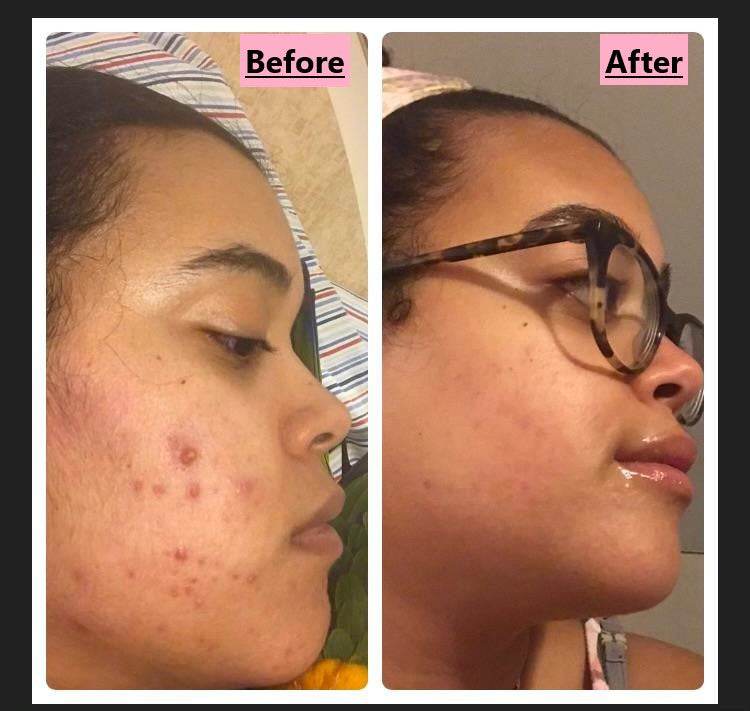 Acne face wash soap bar results