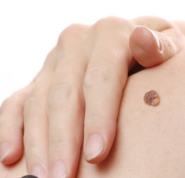 hand near skin wart on body.
